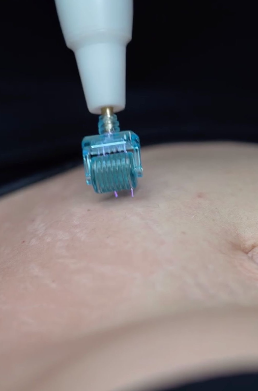 microneedling cold plasma microneedling cold plasma
