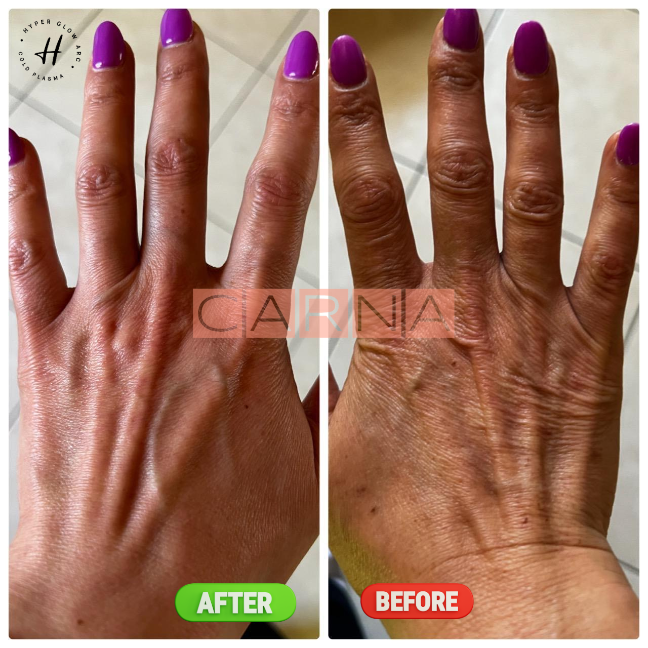 cold plasma before after Adsiz tasarim
