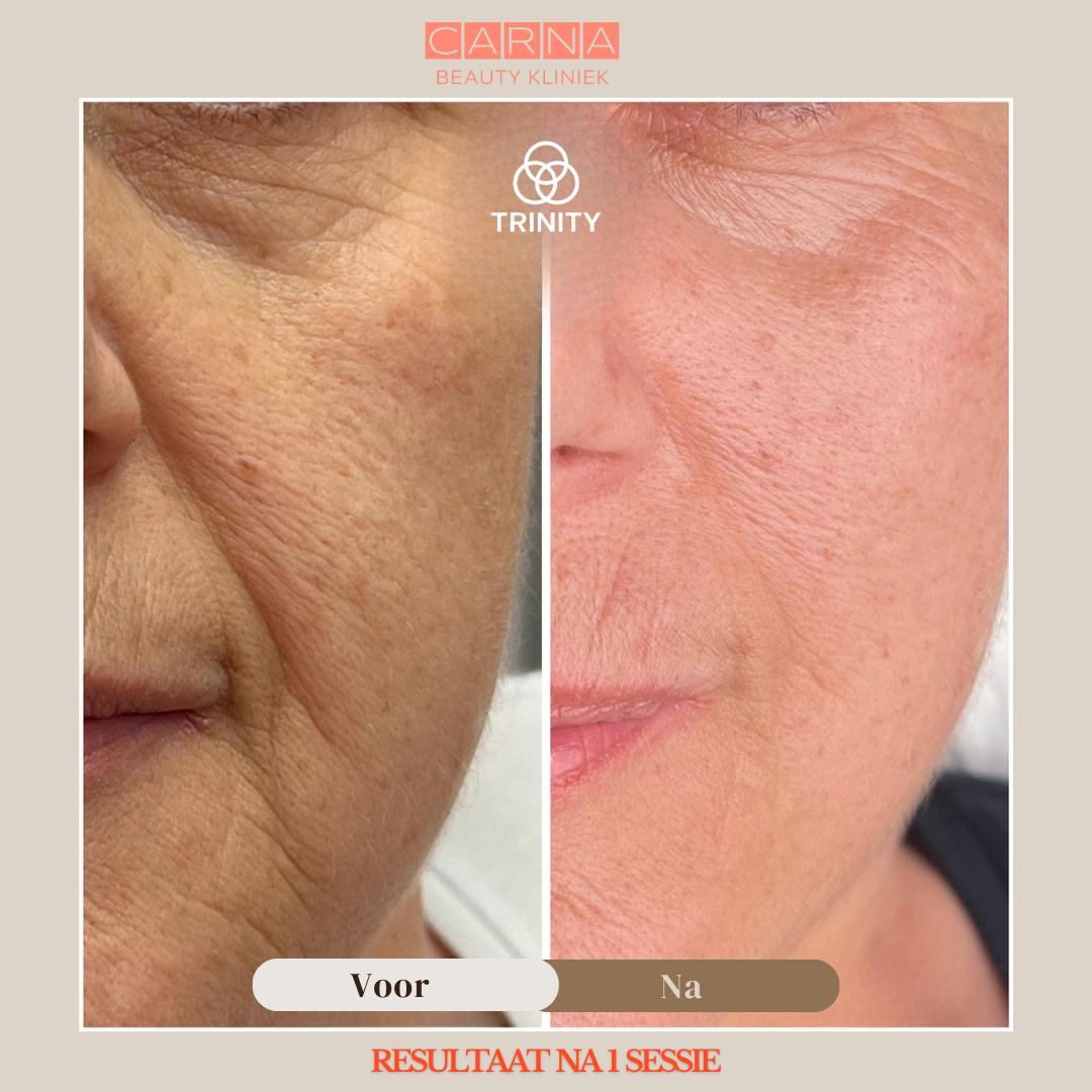 jawline wrinkles treatment 10 kopyasi