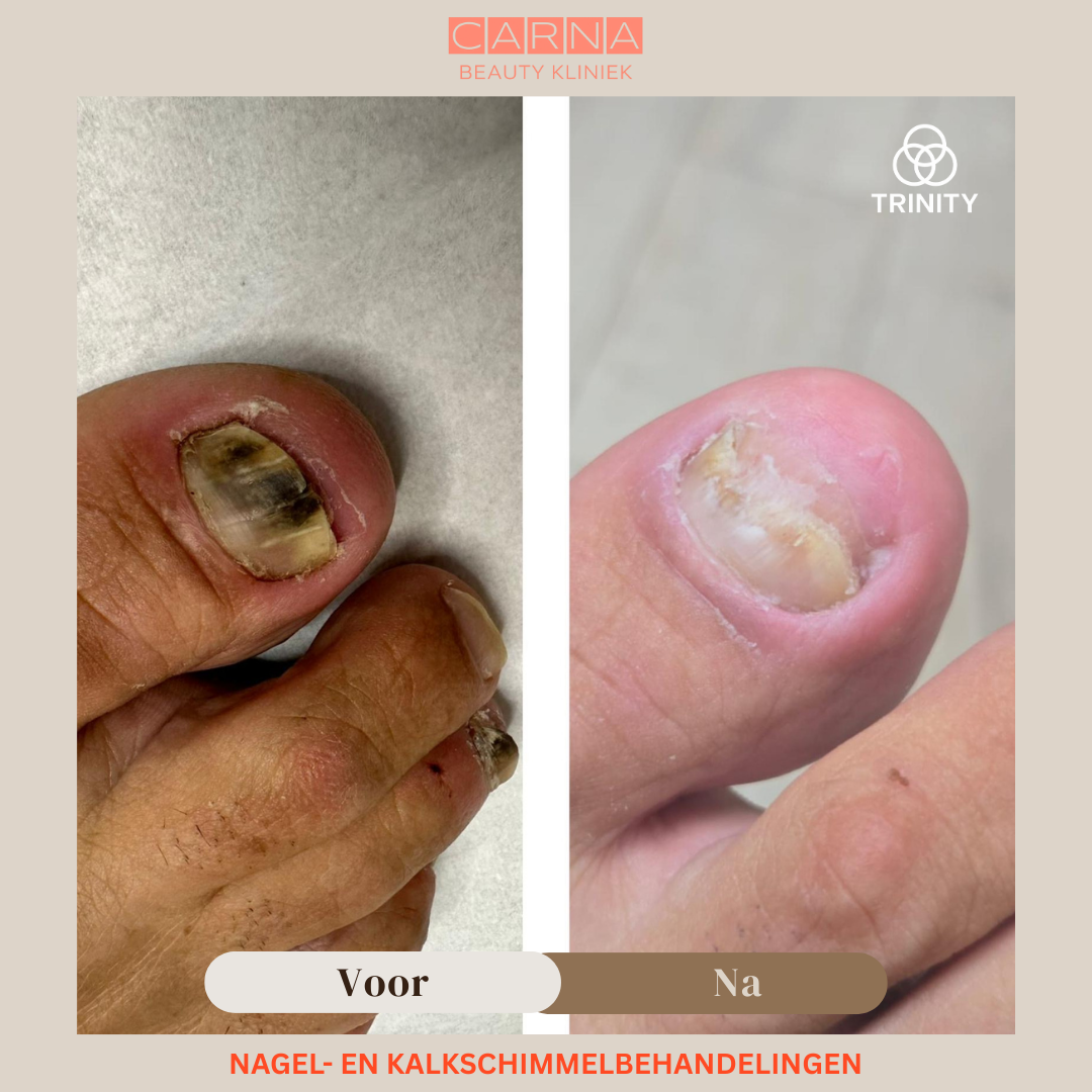 trinity nail fungs treatment result 10