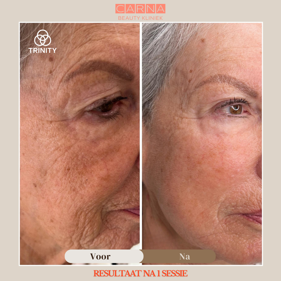 trinity results, cold plasma, carna medical, carnamed, amsterdam skin treatment 6