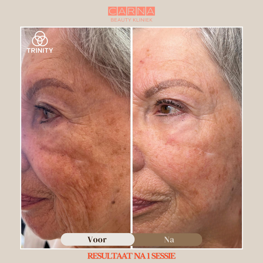 trinity hyper skin booster result 8