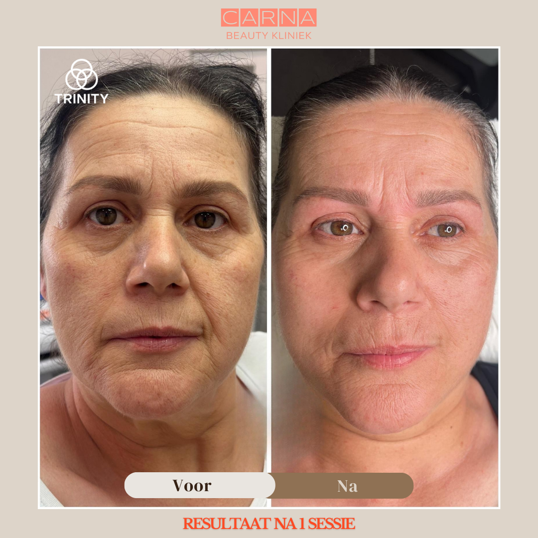 Trinity Hyper face session result 9