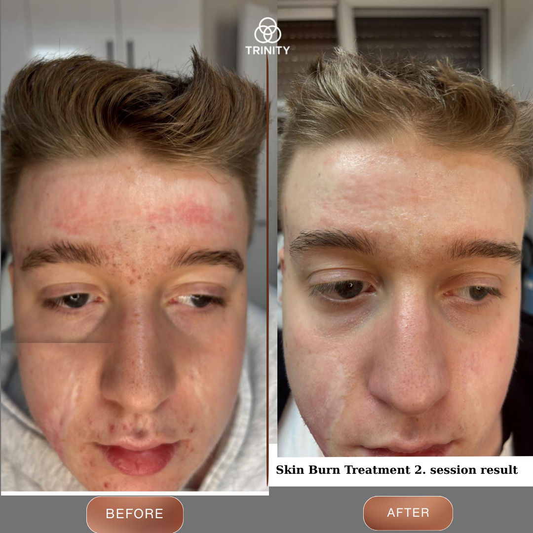 skin burn treatment-trinity-carna medical technology ems 1