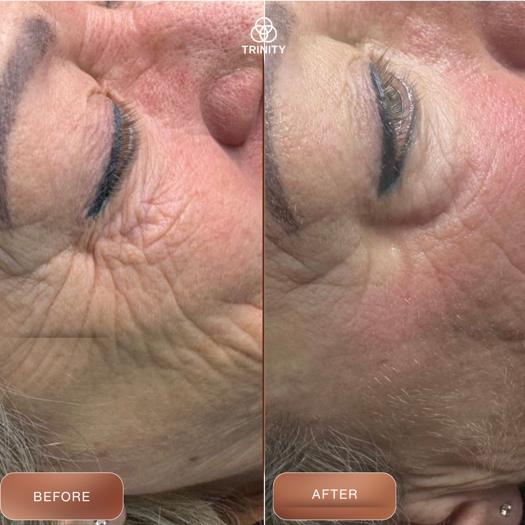 trinity wrinkle treatment- no botox ems